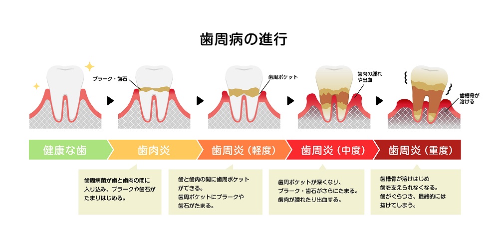 歯周病の進行ステージについて 歯周病の進行ステージについて