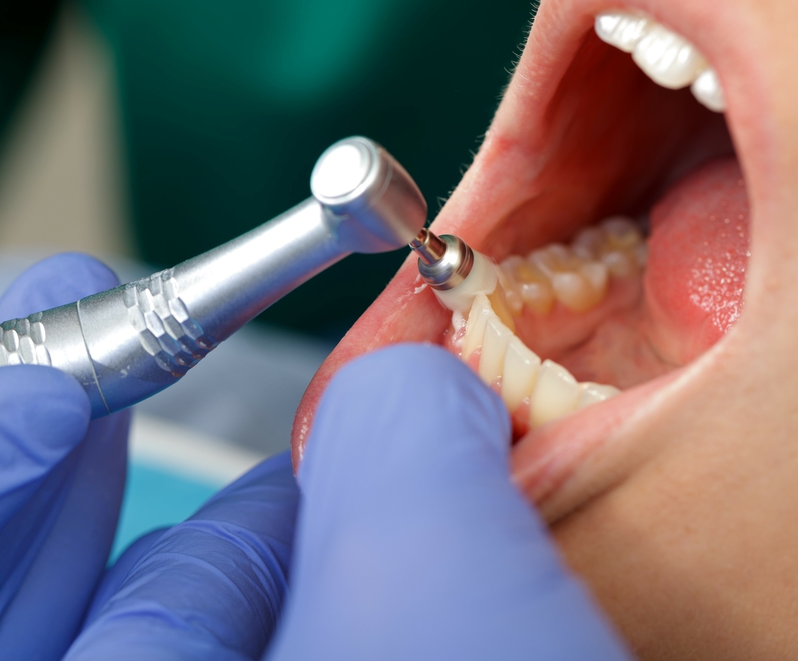 クリーニング
